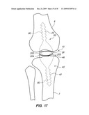 IMPLANTABLE BRACE FOR PROVIDING JOINT SUPPORT diagram and image