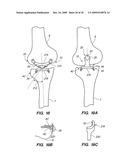 IMPLANTABLE BRACE FOR PROVIDING JOINT SUPPORT diagram and image