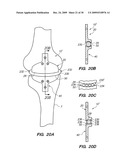 IMPLANTABLE BRACE FOR PROVIDING JOINT SUPPORT diagram and image