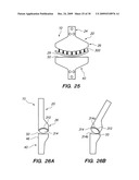 IMPLANTABLE BRACE FOR PROVIDING JOINT SUPPORT diagram and image