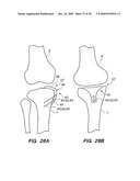 IMPLANTABLE BRACE FOR PROVIDING JOINT SUPPORT diagram and image