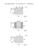 TRANSVASCULAR BALLOON CATHETER WITH PACING ELECTRODES ON SHAFT diagram and image