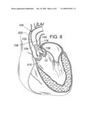 RETAINING MECHANISMS FOR PROSTHETIC VALVES diagram and image