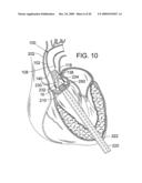 RETAINING MECHANISMS FOR PROSTHETIC VALVES diagram and image