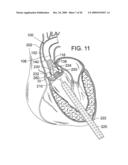 RETAINING MECHANISMS FOR PROSTHETIC VALVES diagram and image