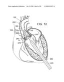 RETAINING MECHANISMS FOR PROSTHETIC VALVES diagram and image