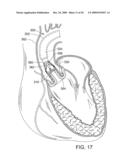 RETAINING MECHANISMS FOR PROSTHETIC VALVES diagram and image