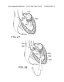 RETAINING MECHANISMS FOR PROSTHETIC VALVES diagram and image