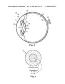 TORIC INTRAOCULAR LENS WITH MODIFIED POWER CHARACTERISTICS diagram and image