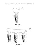 CONDENSING SKELETAL IMPLANT THAT FACILITATE INSERTIONS diagram and image