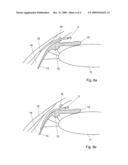 OCULAR IMPLANT diagram and image