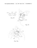 PATIENT INTERFACE SYSTEMS diagram and image