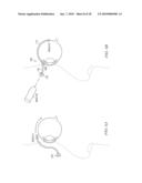 METHODS AND DEVICES FOR MINIMALLY-INVASIVE EXTRAOCULAR DELIVERY OF RADIATION TO THE POSTERIOR PORTION OF THE EYE diagram and image