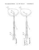 METHOD EMPLOYING A DRAINAGE CATHETER ASSEMBLY FOR DELIVERING A CATHETER TO A BODY diagram and image