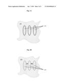  Method for Decreasing the Size and/or Changing the Shape of Pelvic Tissues diagram and image