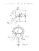 ANCHORING SYSTEM FOR DISC REPAIR diagram and image