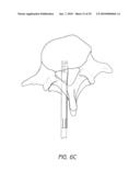 ANCHORING SYSTEM FOR DISC REPAIR diagram and image