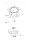 ANCHORING SYSTEM FOR DISC REPAIR diagram and image