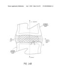 ANCHORING SYSTEM FOR DISC REPAIR diagram and image