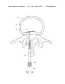 ANCHORING SYSTEM FOR DISC REPAIR diagram and image