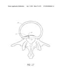 ANCHORING SYSTEM FOR DISC REPAIR diagram and image