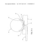 METHODS AND DEVICES FOR THE TREATMENT OF ANEURYSMS diagram and image