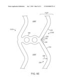 Polymeric Stent diagram and image