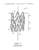 Polymeric Stent diagram and image