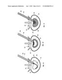 Mechanical apparatus and method for artificial disc replacement diagram and image