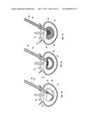 Mechanical apparatus and method for artificial disc replacement diagram and image