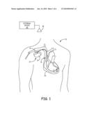 System and Method for Improved Ischemia and Acute Myocardial Infarction Detection diagram and image