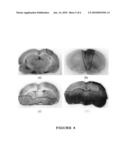 Noninvasively low-frequency ultrasonic apparatus for the brain therapy diagram and image