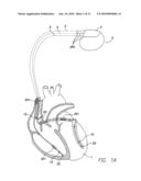 IMPLANTABLE MEDICAL LEAD INCLUDING A SENSOR diagram and image