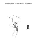 PERCUTANEOUS HEART VALVE WITH STENTLESS SUPPORT diagram and image