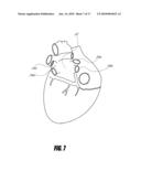 PERCUTANEOUS HEART VALVE WITH STENTLESS SUPPORT diagram and image