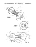 Devices for the Treatment of Vascular Aneurysm diagram and image