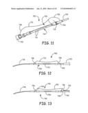 Devices for the Treatment of Vascular Aneurysm diagram and image