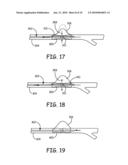 Devices for the Treatment of Vascular Aneurysm diagram and image