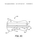 Devices for the Treatment of Vascular Aneurysm diagram and image