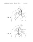 MODULAR IMPLANTABLE MEDICAL DEVICE diagram and image