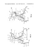 Vascular Prosthesis for the Treatment of Abdominal Aortic Aneurysms Using A Combined Laparoscopic/Open and Endovascular Technique, and Delivery System For Releasing A Prosthesis Fitted With Anchoring Stents diagram and image