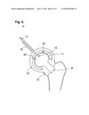 Femoral Head Surgical Resurfacing Aid diagram and image