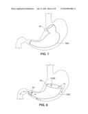 SATIATION DEVICES AND METHODS diagram and image