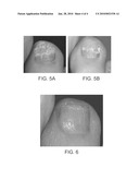 ENHANCED TRANS-KERATIN DRUG DELIVERY diagram and image