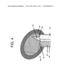 TISSUE MODIFICATION DEVICES AND METHODS OF USING THE SAME diagram and image