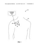 IMPLANTABLE OPTICAL HEMODYNAMIC SENSOR INCLUDING AN EXTENSION MEMBER diagram and image