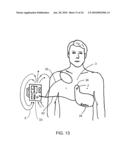 CPR ASSIST DEVICE FOR MEASURING COMPRESSION VARIABLES DURING CARDIOPULMONARY RESUSCITATION diagram and image