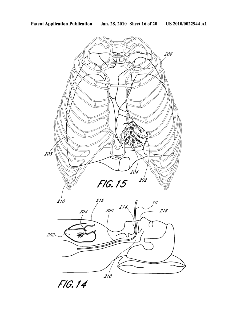 METHOD AND APPARATUS FOR TREATING AN ACUTE MYOCARDIAL INFARCTION - diagram, schematic, and image 17