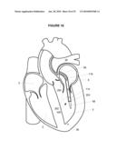 Steerable Catheter and Dilator and System and Method for Implanting a Heart Implant diagram and image