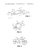 Ostomy appliance apparatus diagram and image